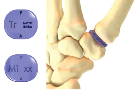 Different sized trial implants used to select best fit.