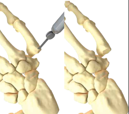 Metacarpal base cut with saw.